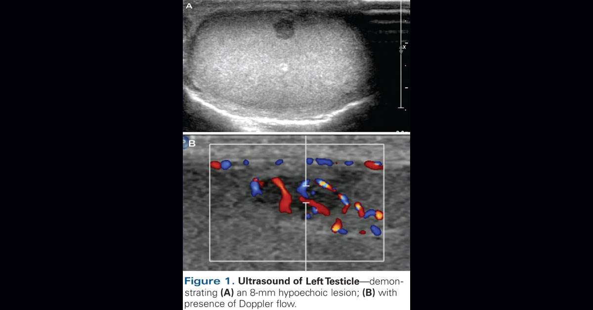 A Case Of Nonpalpable Intratesticular Mass